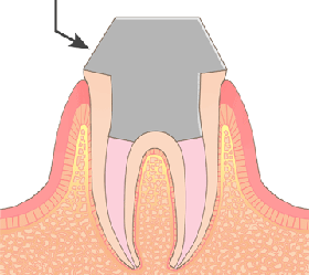 歯の土台（コア）
