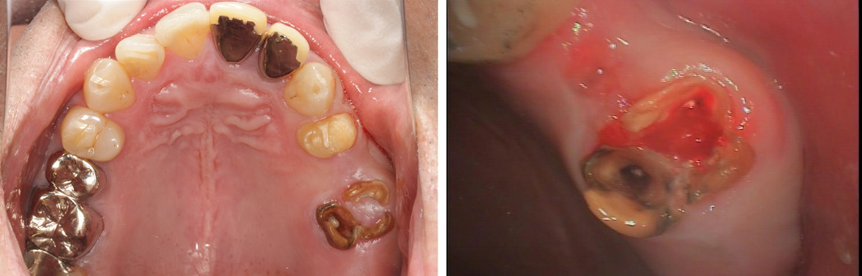 歯牙移植の難症例