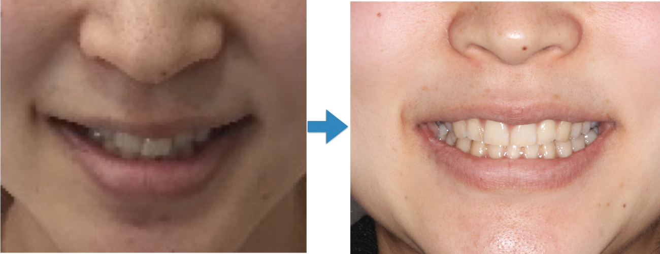 前歯の歪みを矯正する治療の前後のイメージ