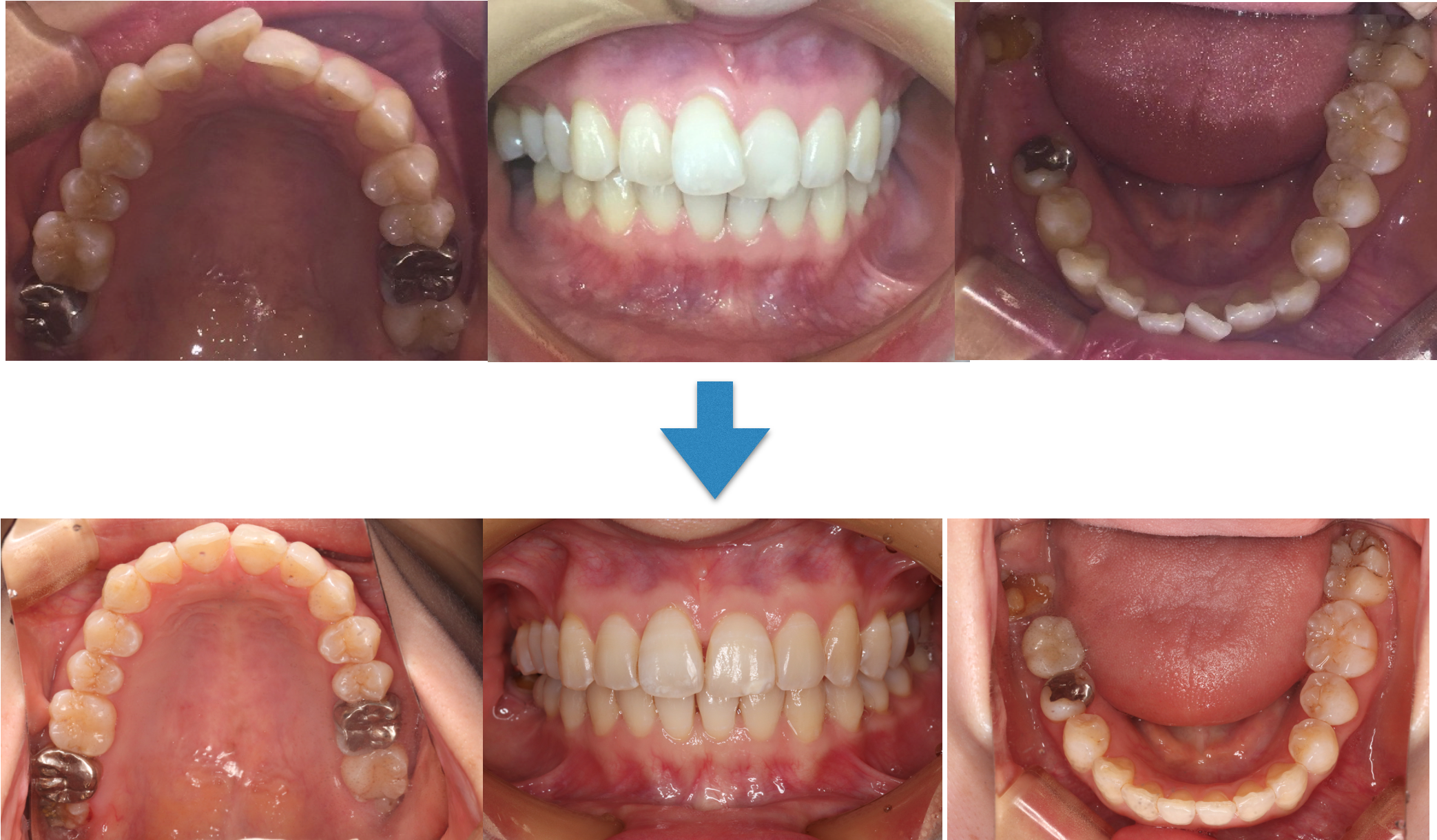 出っ歯を矯正する治療の前後のイメージ