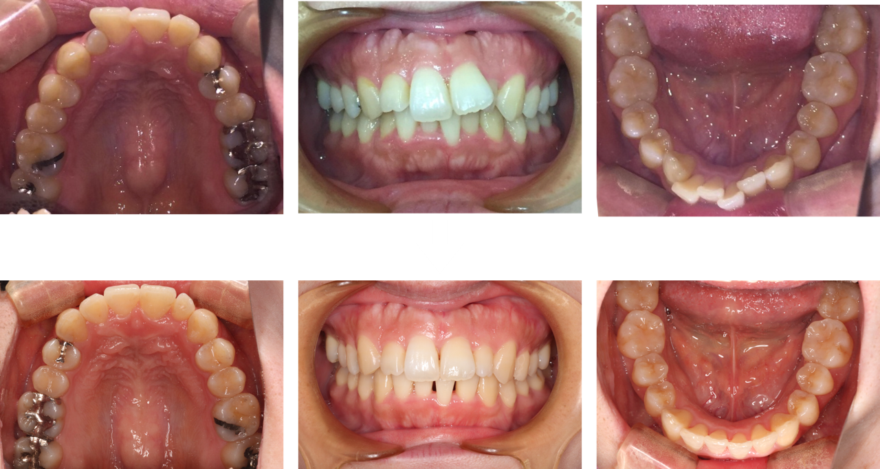 上下の前歯を矯正する治療の前後のイメージ