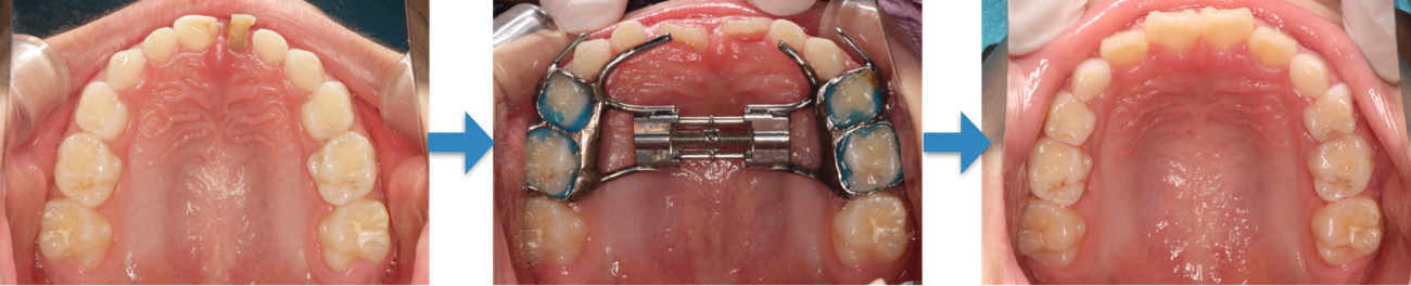 急速側方拡大装置による矯正前後のイメージ