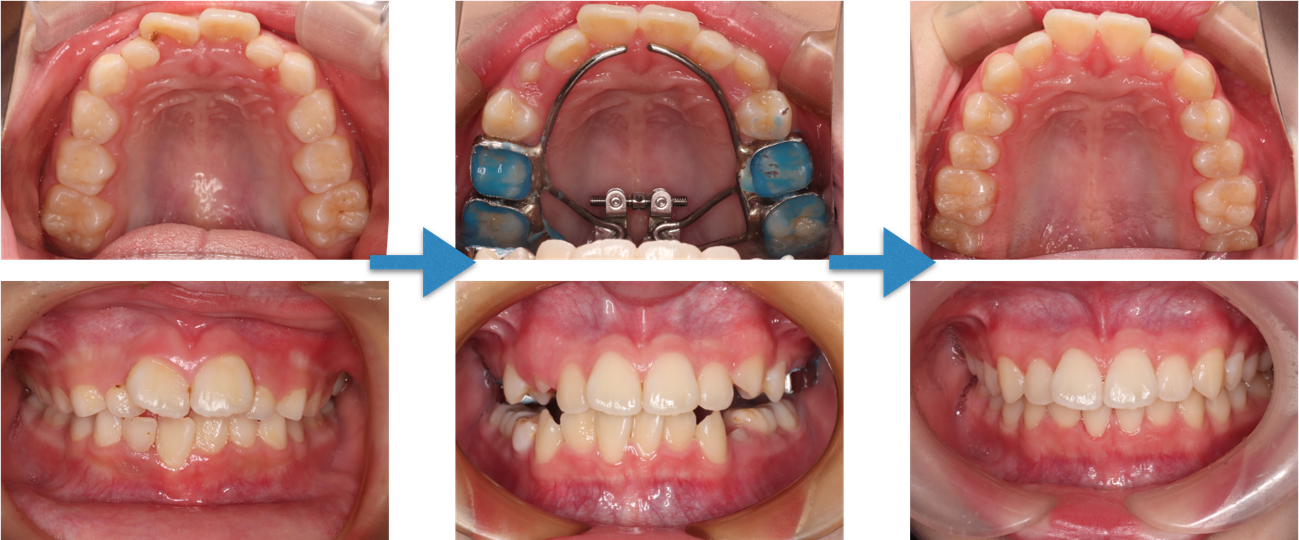 急速前方拡大装置による矯正前後のイメージ