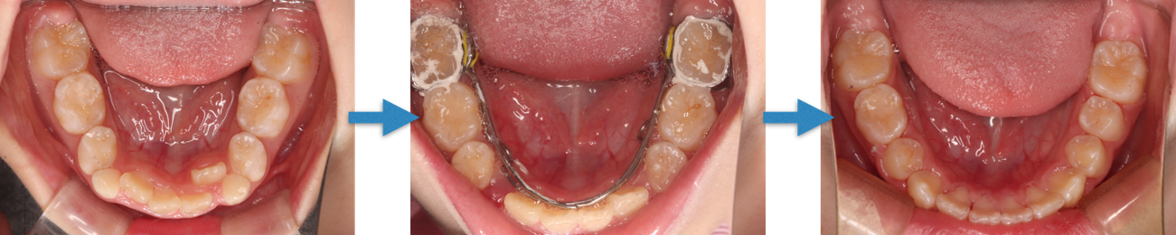 下顎拡大装置による矯正前後のイメージ