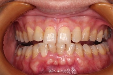 エアフローを用いたクリーニング前の写真