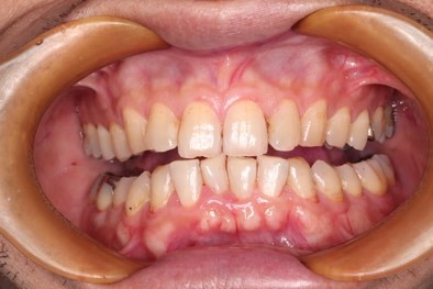 エアフローを用いたクリーニング後の写真