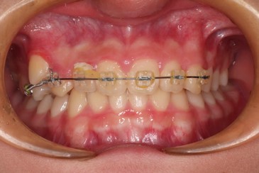 ワイヤー矯正の写真