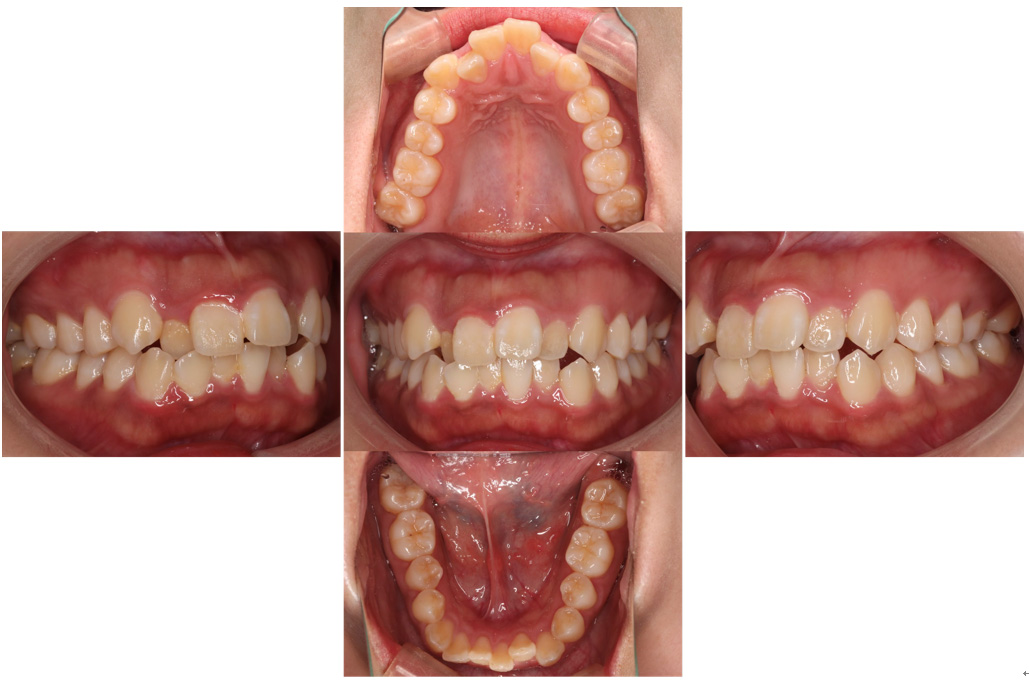 ワイヤー矯正前の写真